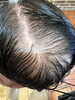 ヘアカラーかぶれ、薄毛でお悩みのお客様「【小樽】頭皮のかゆみ・かぶれ・ヒリヒリ、髪のダメージで悩む40〜50代へ｜髪の駆け込み寺」