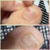 割れた足の爪のBefore・After写真「足の爪のトラブルはドクターネイル爪革命大阪福島店にお任せ🤗大阪駅から2駅にあるトラブル足に特化したサロン👟」