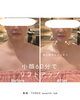 切らない小顔ビフォーアフター「threeの切らない小顔ケア🪄ブライダル/イベント前にもオススメメニューがキャンペーン価格に✨」