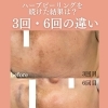 ハーブピーリングを続けた結果は？3回、6回の違い《米子ハーブピーリング》