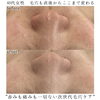 「劇的ビフォーアフター毛穴編【福井毛穴サロン/福井毛穴汚れ/福井復元フェイシャル】」