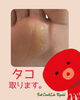 タコ、取ります。「【角質ケア】タコ取り！その奥には…⁈」