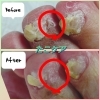 たこケアのBefore・After「たこケア」