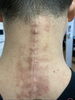 頸椎ヘルニア術後「（続）腕の痛み・首のしびれ・頭痛のある方必見　part②」