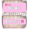 「産まれて初めて『歯を褒められた！』メディカルホワイトニング症例」