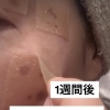 「全部のシミが綺麗に剥けました！」嬉しいお声