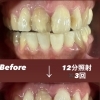 オフィスホワイトニングを行いました🦷