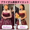 ブライダルダイエット「結婚式で綺麗にドレスを着たい‼️3ヶ月で-9.5kg達成し別人へ生まれ変わりまさした」