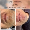 ヒゲ脱毛半年・10回施術のビフォーアフターをご紹介