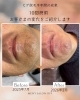 10回施術でヒゲの成果を実感「ヒゲ脱毛半年・10回施術のビフォーアフターをご紹介」