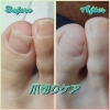 爪もストレスを感じています👣😳👣「あなたの爪はストレスを感じていませんか⁉️爪切ケアのBefore・After👣大阪駅から2駅にある足トラブルに特化したフットケアサロン✨✨」