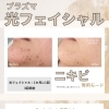 大好評につき！延長プラズマ光フェイシャル✨
