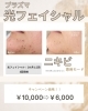 ニキビ肌改善！光フェイシャル体験「大好評につき！延長プラズマ光フェイシャル✨」