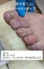 巻き爪・悩める爪のプロケア「【爪切りケア】厚くなった爪を整えてスッキリした足元に」