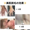男性にも選ばれる美肌脱毛事例のご紹介