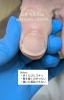 巻き爪にお悩みの方へ「【巻き爪補正】歩くたびにズキッ…のお悩みをケアしました」