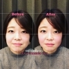 【小顔矯正ビフォーアフター１６】