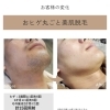 おヒゲ脱毛ビフォーアフター　～早岐脱毛・リラクゼーション・毛穴洗浄・光フェイシャル～
