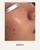 肌悩みを「Before→After」「ジェネオプラス1回で実感 小鼻すっきり＆つるんと艶肌へ」