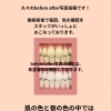 歯の色で印象はこんなに変わる？セルフホワイトニングbefore after