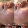 フォトとハーブピーリングで内側から美しい肌に。ハイドラ毛穴洗浄×光フォト×ハーブピーリング初回9,900円