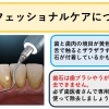 歯石は歯ブラシでは取れません―プロのクリーニングでスッキリと