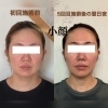 驚くほどの小顔変化、最短5回で実現「5回の小顔施術でここまで変化！ビフォーアフターのご紹介」