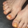 毎月の巻き爪ケアでフットネイルも楽しめます｜三島市mignon