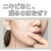 ニキビは治ったのに“跡だけ残る”理由とおすすめケア【米子・松江・境港・伴走型エステ】