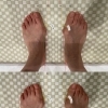 【外反母趾は改善できます｜湖南市石部の吉越整骨院の症例紹介】