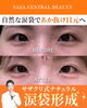涙袋ヒアル「👀自然な涙袋で優しい目元に✨ ナチュラル涙袋形成（涙袋ヒアル）をサザクリで始めました👀」