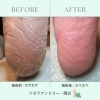 ひび割れかかとがスベスベに！施術前後の変化をご紹介