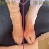 外反母趾の対応について