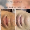 ヒゲ脱毛10ヶ月の成果をご紹介します【口元ビフォーアフター】