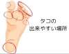 こんな場所にタコありませんか？「身体の基礎は「足」です。」