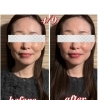 八王子でエラ張りが気になる方へ｜食いしばりケアでフェイスラインをやさしくスッキリ