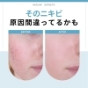 ニキビが繰り返しできる原因｜実は見直すべきポイントとは？