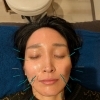 セラピストの休日、美容鍼でメンテナンスしてきました