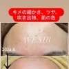 1年半後、あなたの肌はどっち？　美濃市、関市、郡上市、各務原市、美濃加茂市、岐阜県民でお肌悩みのある方はアベニールへ！【岐阜県美濃市、毛穴専門サロンアベニール】