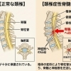 マツコ・デラックスさん緊急入院のニュースから学ぶ【頚椎症性脊髄症】手術という選択前に整体ができること