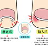 【膝の痛み『巻き爪』や『陥入爪』が原因かも！？】