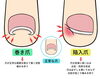 巻き爪と陥入爪「【膝の痛み『巻き爪』や『陥入爪』が原因かも！？】」