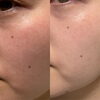 あなたの魅力を最大限に「スキンケアで変わる♡毛穴レスな透明感お肌のお話」