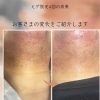 ヒゲ脱毛4回の成果をご紹介【首元ビフォーアフター】