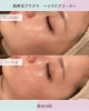 シミ改善！肌再生ダブル効果「肌再生プラズマ《シミ・イボケア》Before→Afterのご紹介」