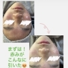 ニキビ・赤み、諦める前に！驚きのビフォーアフター