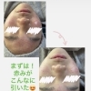 ニキビ・赤み、諦める前に！驚きのビフォーアフター