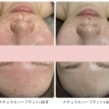 花粉・黄砂による肌のかゆみには、内側から整えるハーブテントケアを