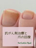 「【がん患者サポート】抗がん剤治療と爪の回復」