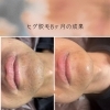 ヒゲ脱毛8ヶ月の結果【口元ビフォーアフター】